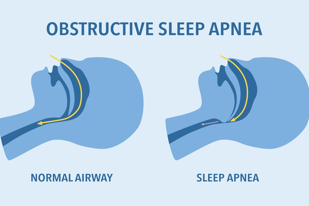 ypniki-apnia-banner1